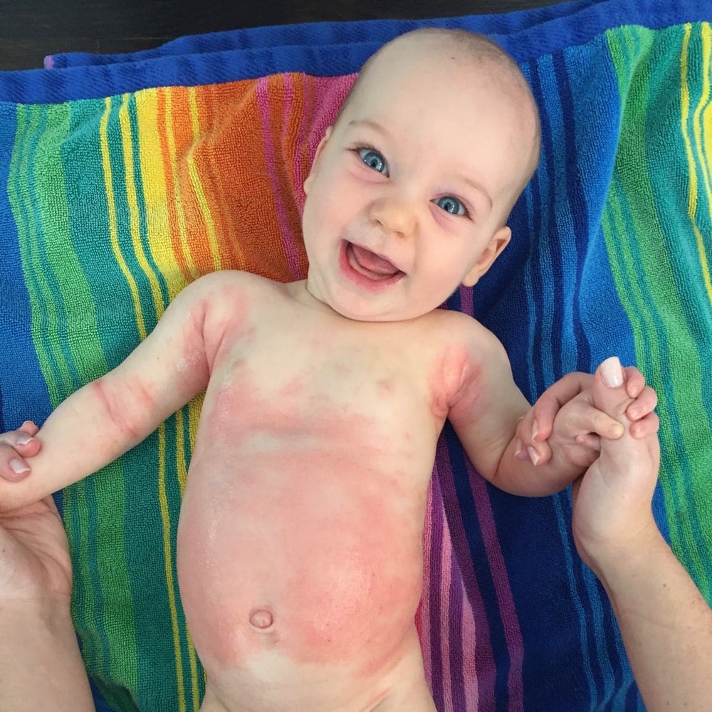 Dealing with Baby Eczema from weelicious.com